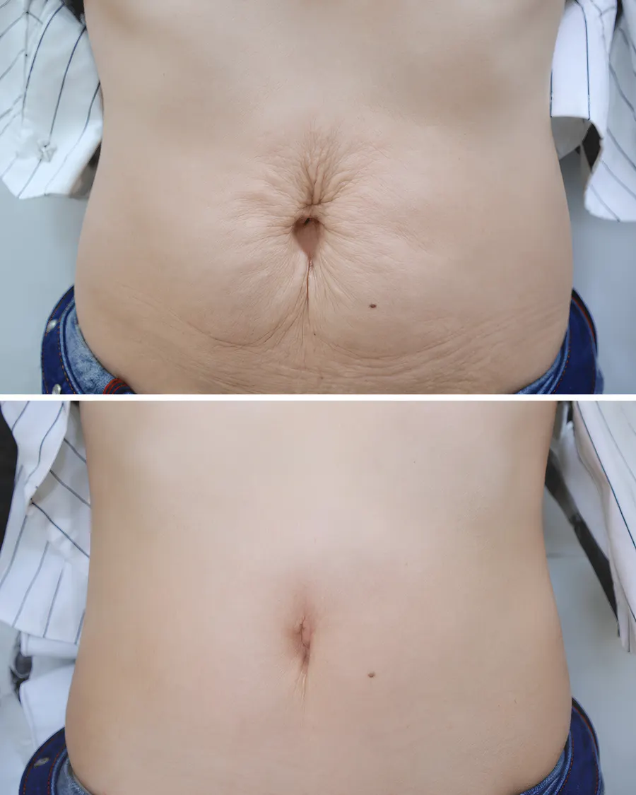 Skin tightening Laser at Cinch Clinics